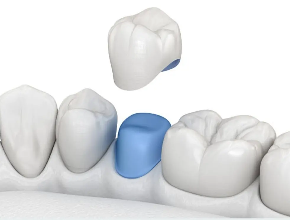 05-protesis-dentales