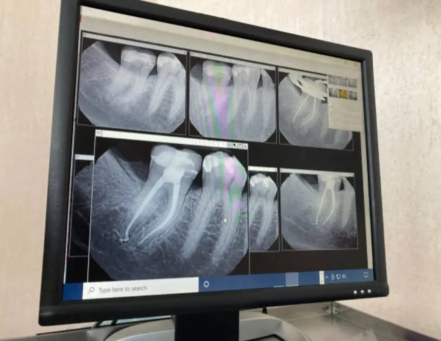 07-endodoncia