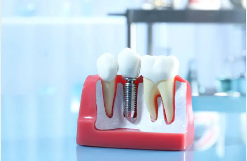 foto_implantes_800px